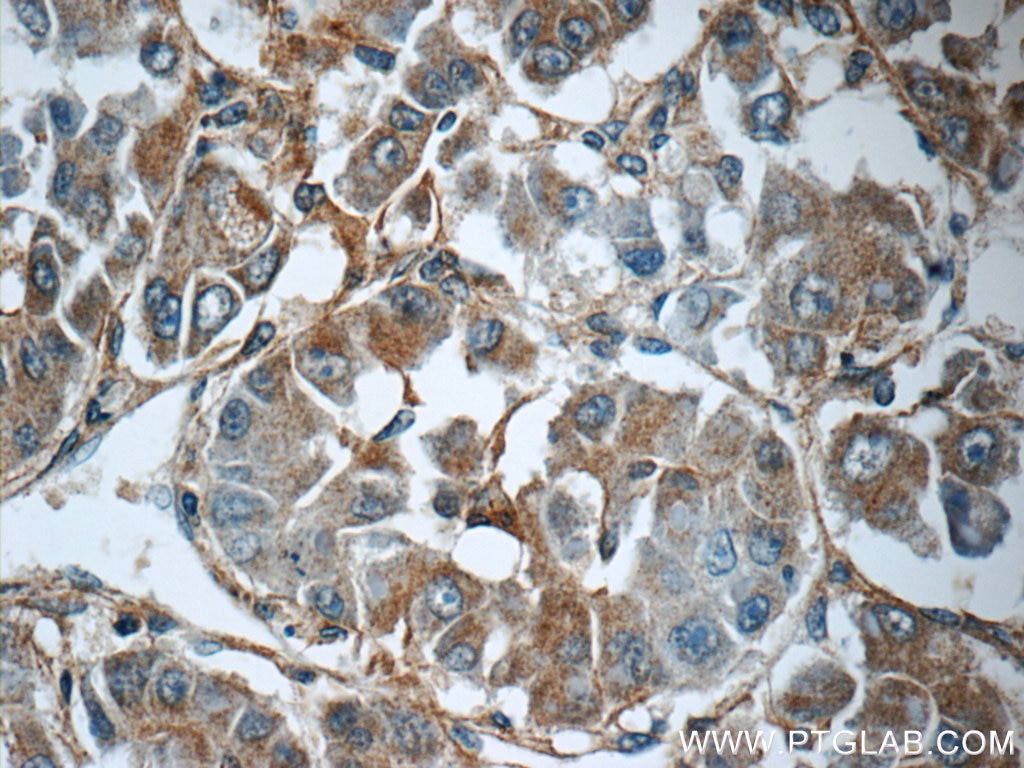 Immunohistochemistry (IHC) staining of human liver cancer tissue using MRPS26 Polyclonal antibody (15989-1-AP)