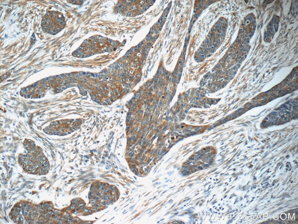 Immunohistochemistry (IHC) staining of human skin cancer tissue using MRPS26 Polyclonal antibody (15989-1-AP)