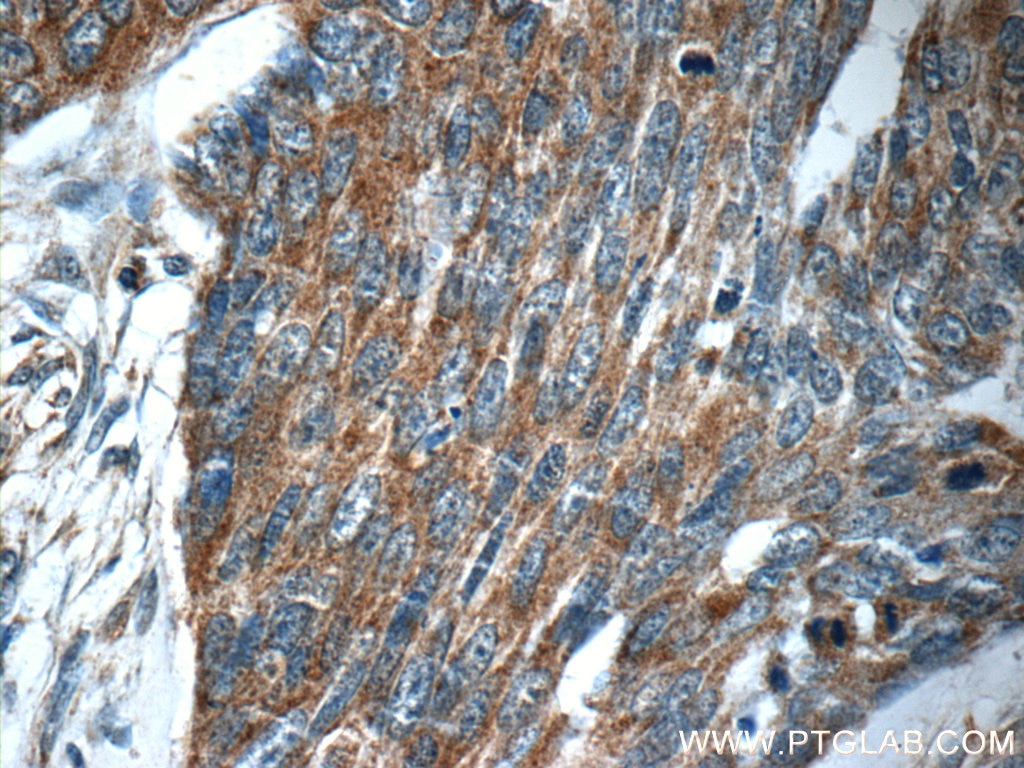 Immunohistochemistry (IHC) staining of human skin cancer tissue using MRPS26 Polyclonal antibody (15989-1-AP)