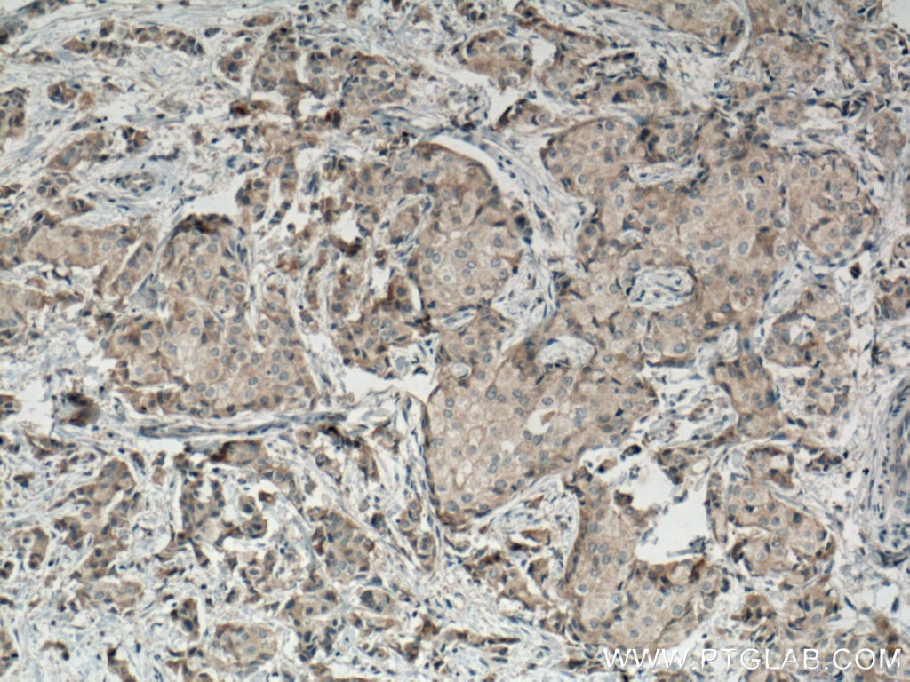 Immunohistochemistry (IHC) staining of human breast cancer tissue using MRPS27 Monoclonal antibody (66724-1-Ig)