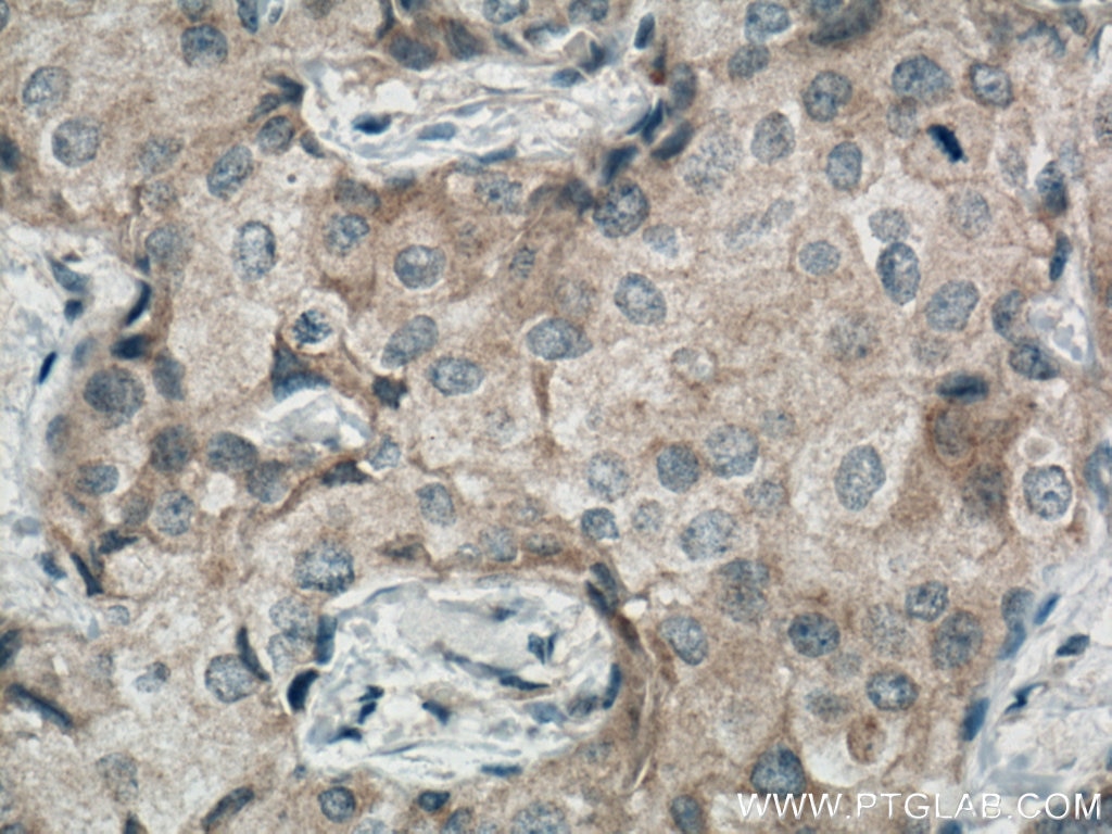 Immunohistochemistry (IHC) staining of human breast cancer tissue using MRPS27 Monoclonal antibody (66724-1-Ig)