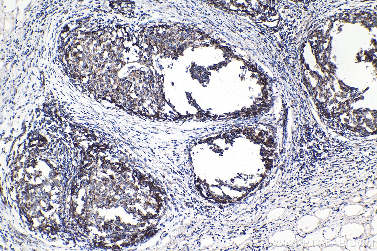 Immunohistochemistry (IHC) staining of human breast cancer tissue using MRPS34 Polyclonal antibody (15166-1-AP)