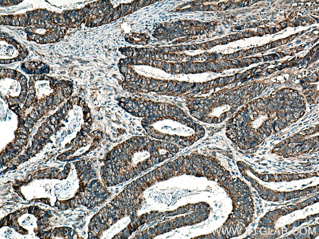 Immunohistochemistry (IHC) staining of human colon cancer tissue using MRPS35 Polyclonal antibody (16457-1-AP)