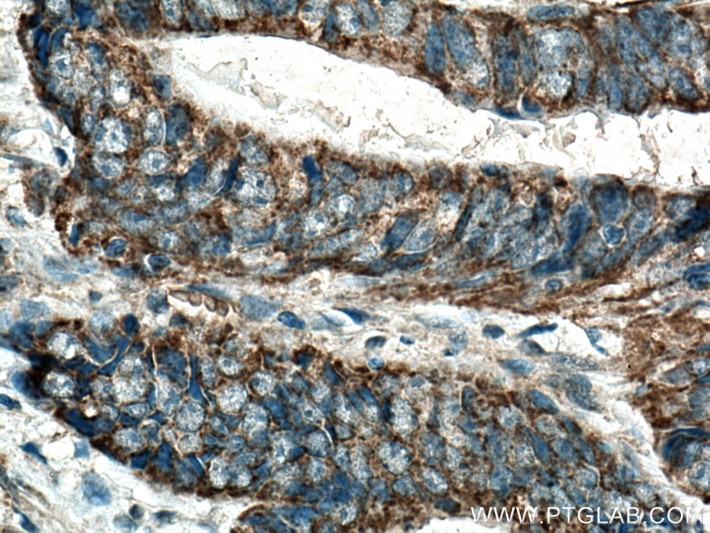 Immunohistochemistry (IHC) staining of human colon cancer tissue using MRPS35 Polyclonal antibody (16457-1-AP)