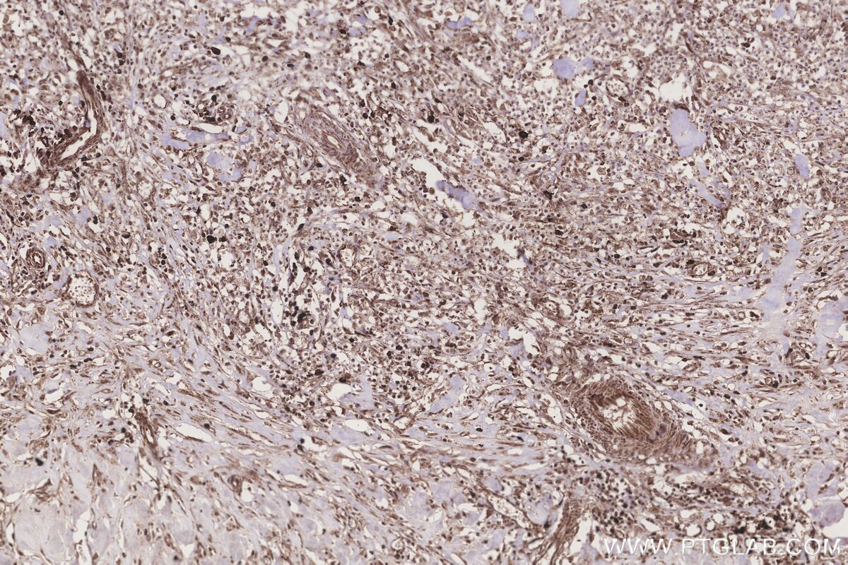 Immunohistochemistry (IHC) staining of human colon cancer tissue using MRPS35 Polyclonal antibody (16457-1-AP)