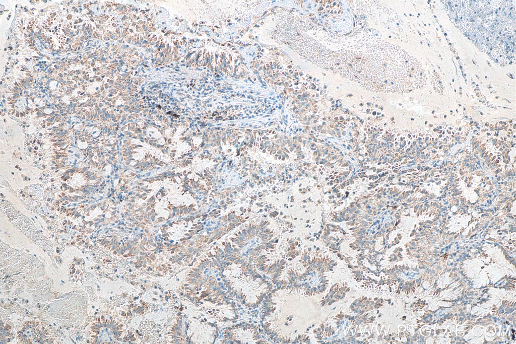 Immunohistochemistry (IHC) staining of human lung cancer tissue using MRPS36 Polyclonal antibody (16279-1-AP)