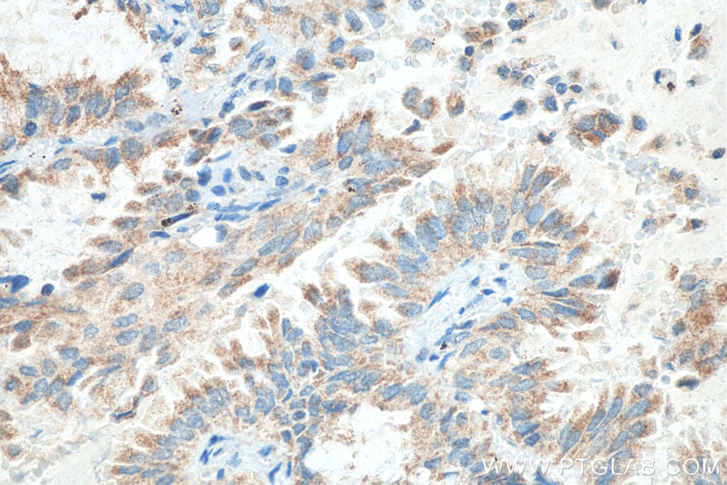 Immunohistochemistry (IHC) staining of human lung cancer tissue using MRPS36 Polyclonal antibody (16279-1-AP)