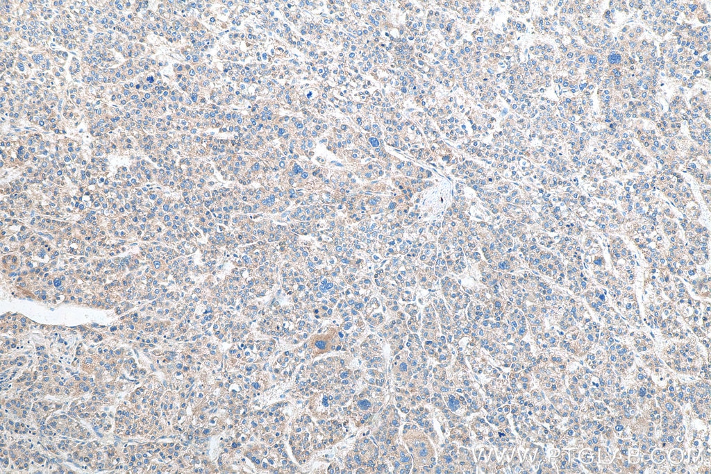 Immunohistochemistry (IHC) staining of human liver cancer tissue using MRPS36 Polyclonal antibody (16279-1-AP)