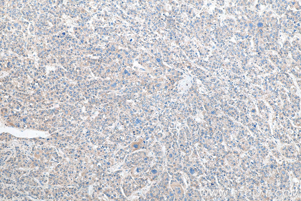 Immunohistochemistry (IHC) staining of human liver cancer tissue using MRPS36 Polyclonal antibody (16279-1-AP)