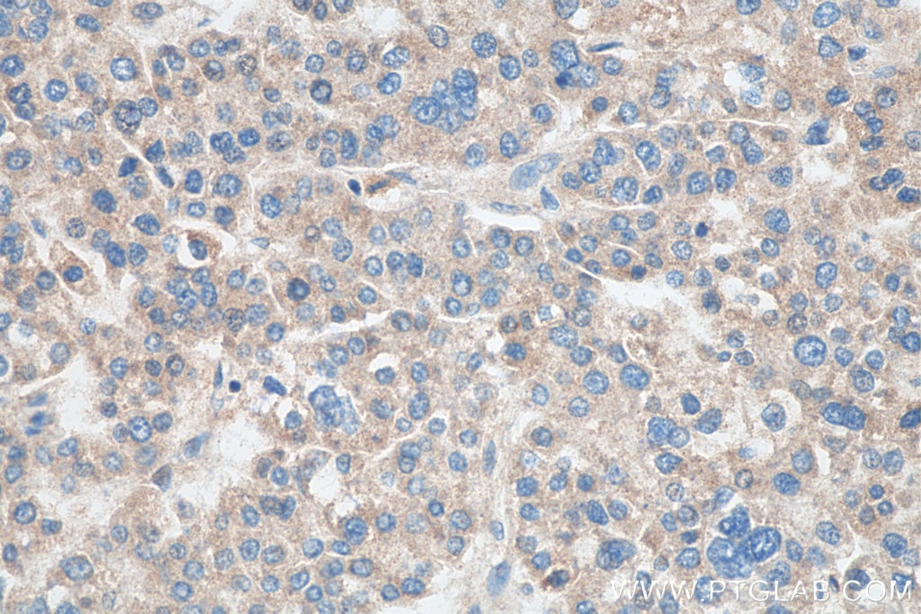 Immunohistochemistry (IHC) staining of human liver cancer tissue using MRPS36 Polyclonal antibody (16279-1-AP)