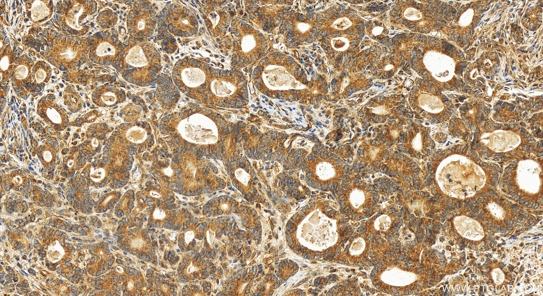 Immunohistochemistry (IHC) staining of human stomach cancer tissue using MRPS6 Polyclonal antibody (16273-1-AP)