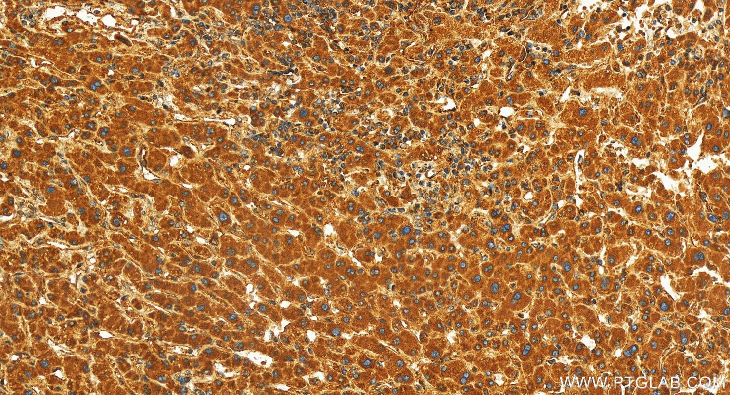 Immunohistochemistry (IHC) staining of human intrahepatic cholangiocarcinoma tissue using MRPS6 Polyclonal antibody (16273-1-AP)