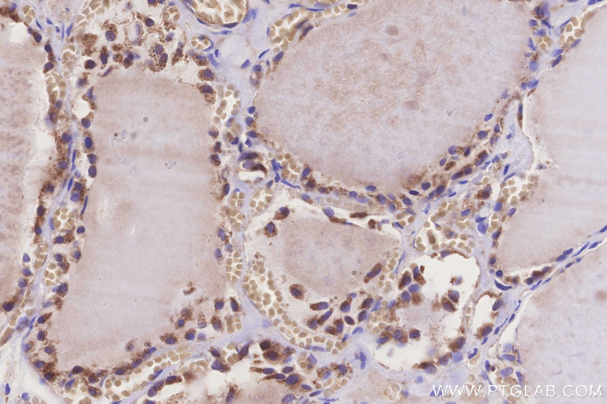 IHC staining of human thyroid cancer using 16273-1-AP Immunohistochemistry (IHC) staining of human thyroid cancer tissue using MRPS6 Polyclonal antibody (16273-1-AP)
