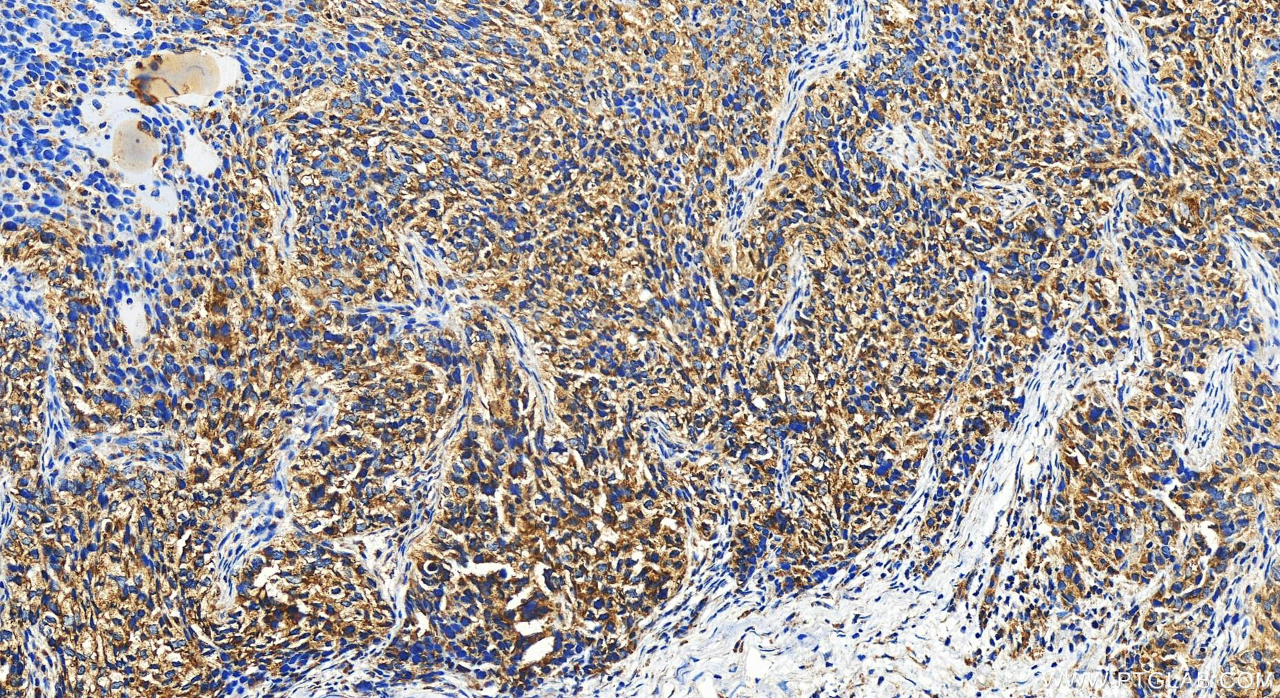 Immunohistochemistry (IHC) staining of human ovary cancer tissue using MRPS6 Polyclonal antibody (16273-1-AP)