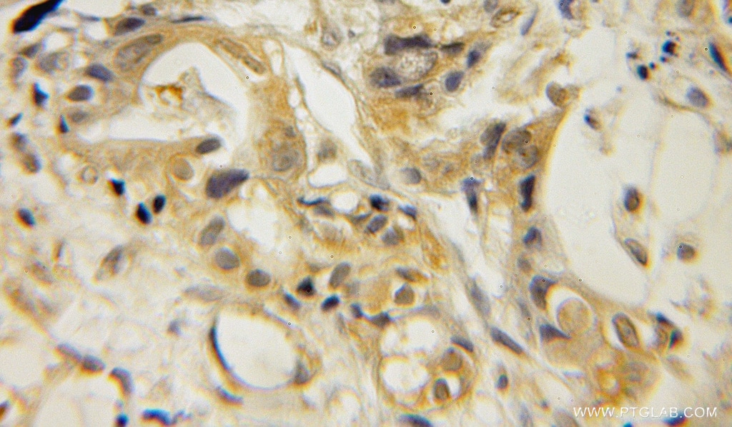 IHC staining of human pancreas cancer using 12357-2-AP