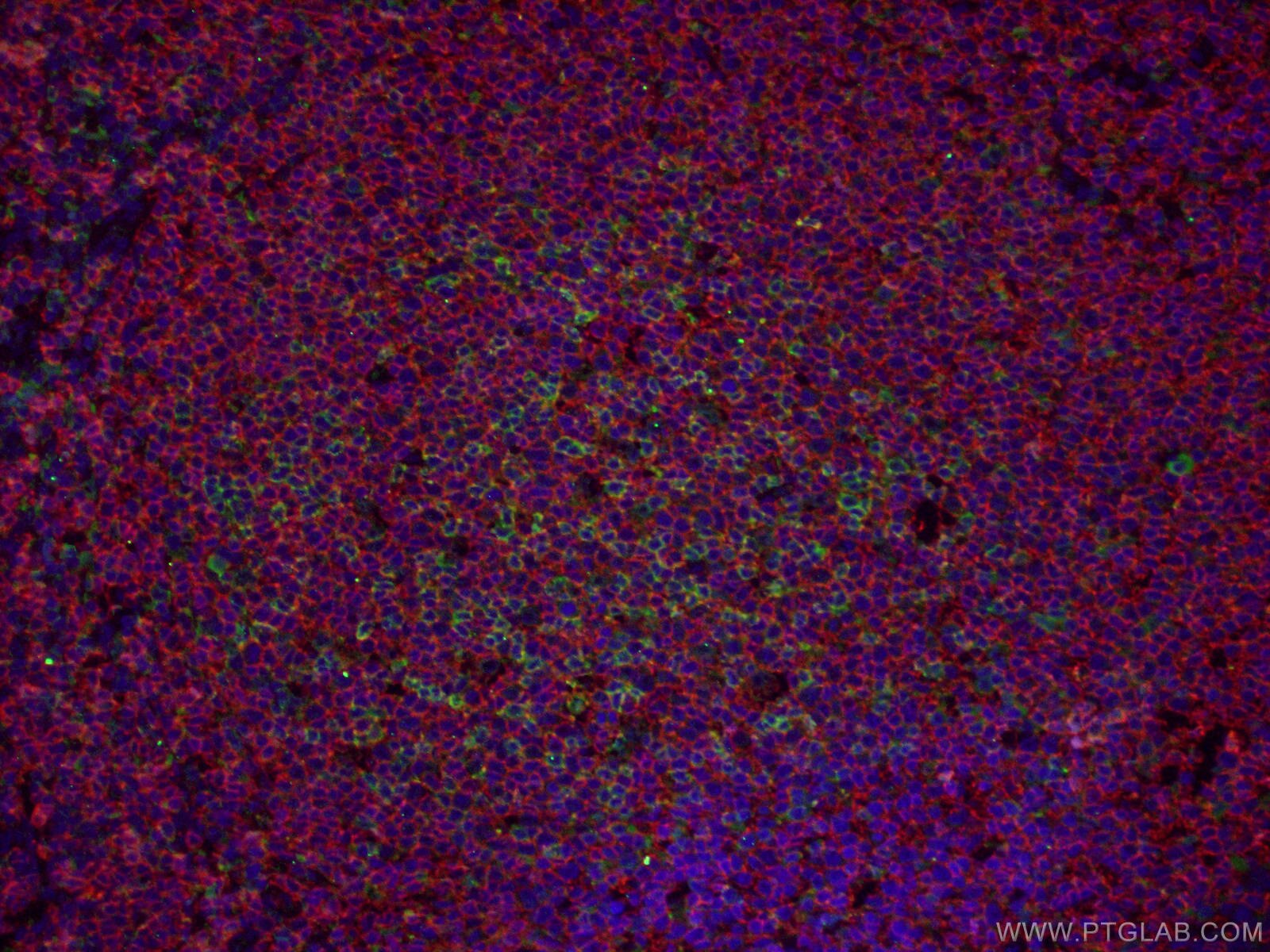 IF Staining of human tonsillitis using 24828-1-AP