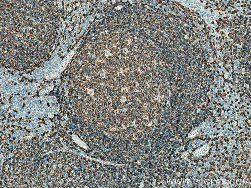 Immunohistochemistry (IHC) staining of human tonsillitis tissue using CD20 Polyclonal antibody (24828-1-AP)