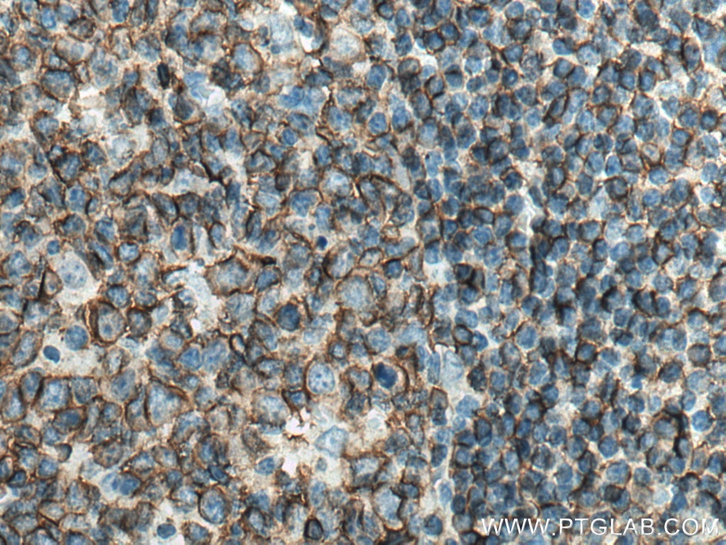 Immunohistochemistry (IHC) staining of human tonsillitis tissue using CD20 Polyclonal antibody (24828-1-AP)