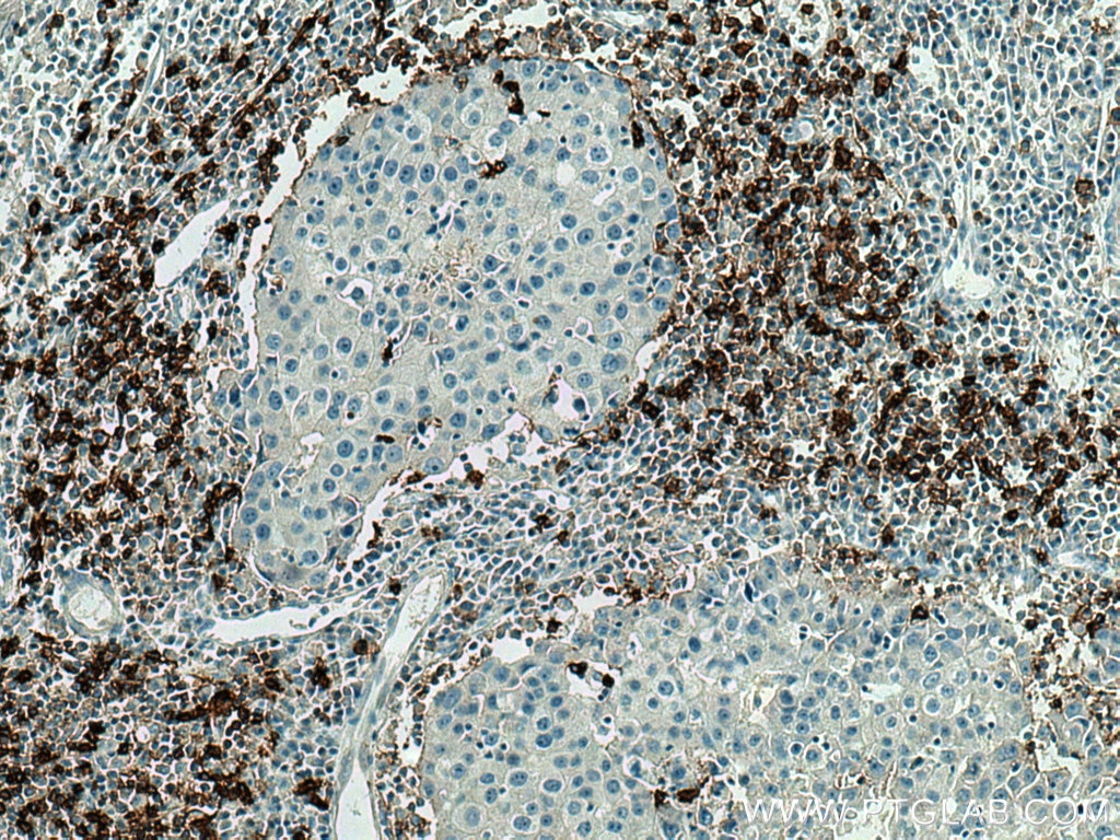 IHC staining of human breast cancer using 24828-1-AP