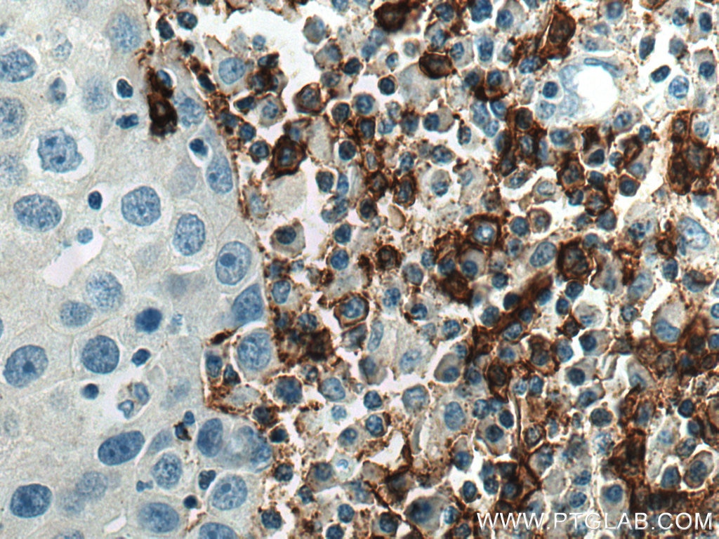 Immunohistochemistry (IHC) staining of human breast cancer tissue using CD20 Polyclonal antibody (24828-1-AP)