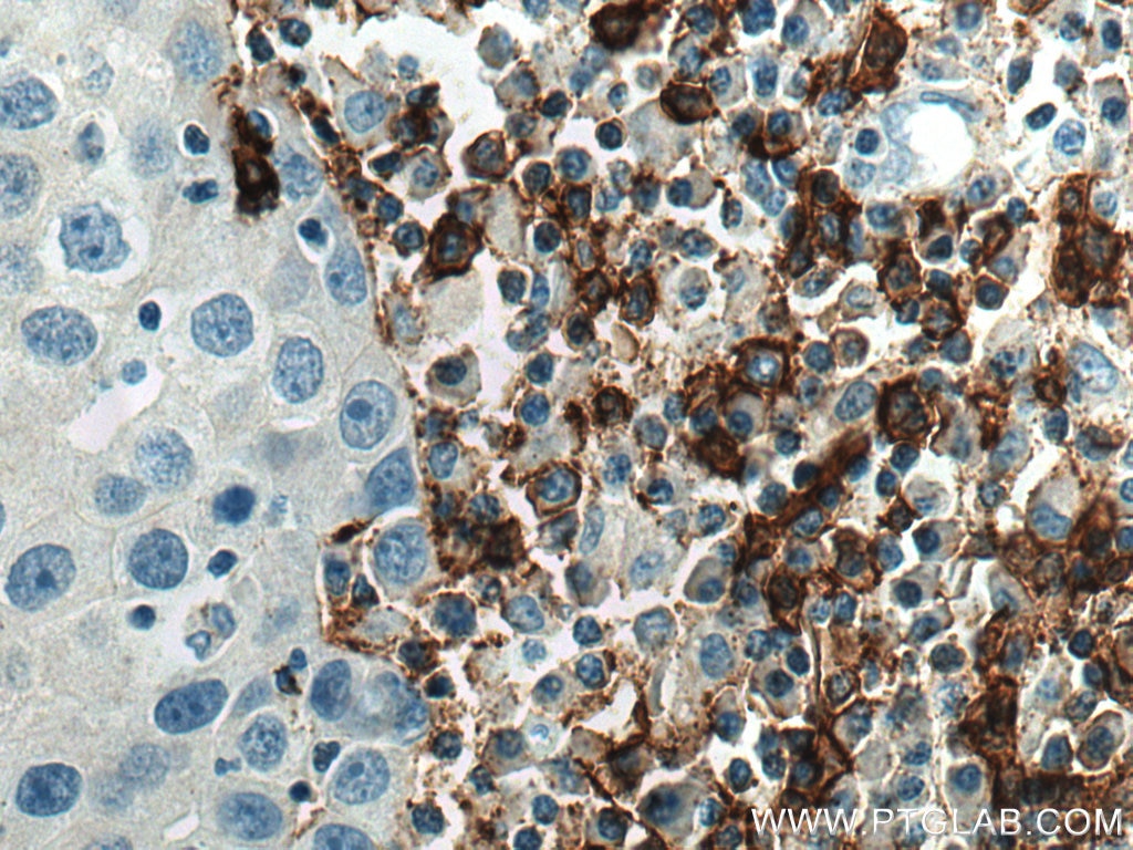 IHC staining of human breast cancer using 24828-1-AP