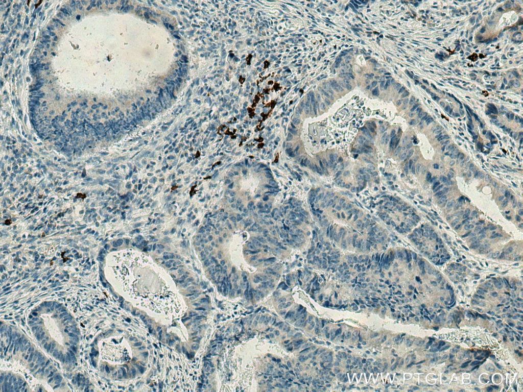 Immunohistochemistry (IHC) staining of human colon cancer tissue using CD20 Polyclonal antibody (24828-1-AP)