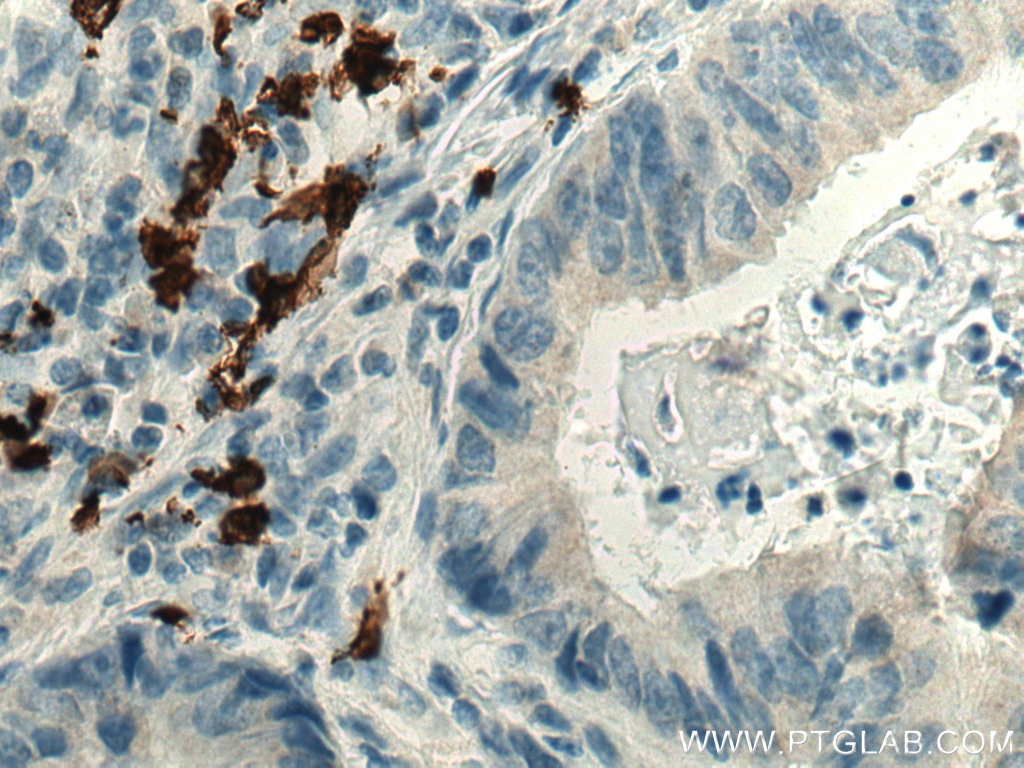 Immunohistochemistry (IHC) staining of human colon cancer tissue using CD20 Polyclonal antibody (24828-1-AP)