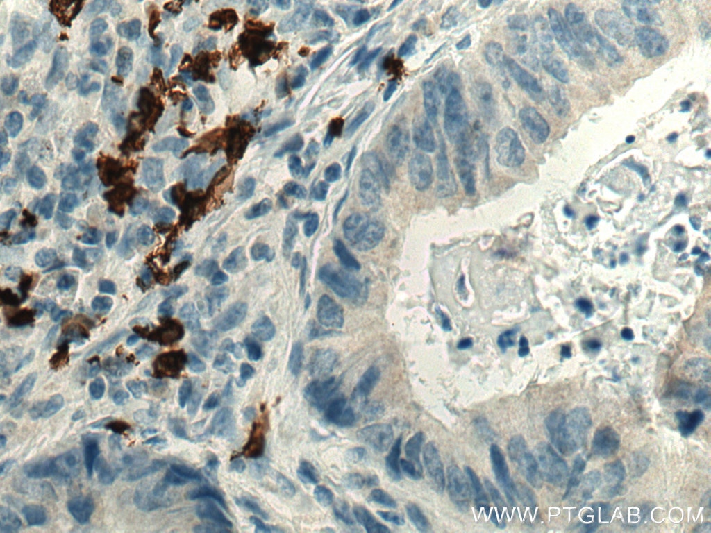 IHC staining of human colon cancer using 24828-1-AP