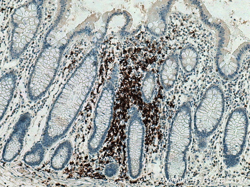 IHC staining of human colon cancer using 24828-1-AP