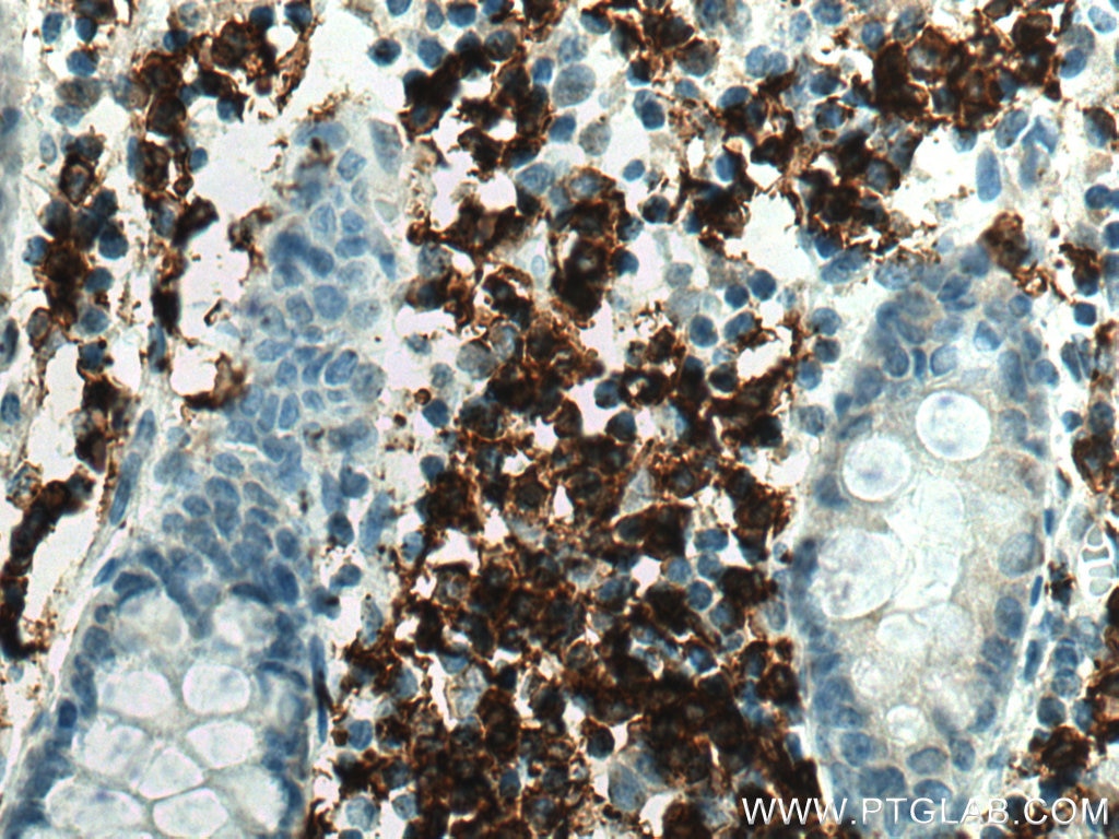 Immunohistochemistry (IHC) staining of human colon cancer tissue using CD20 Polyclonal antibody (24828-1-AP)