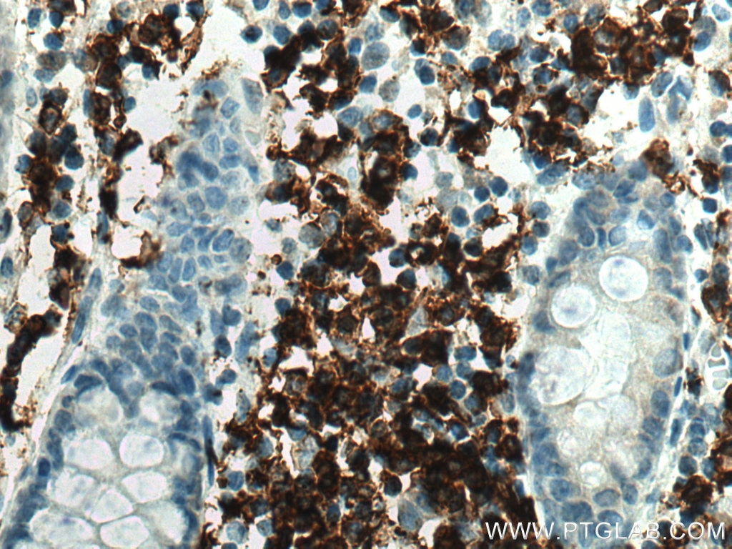 IHC staining of human colon cancer using 24828-1-AP