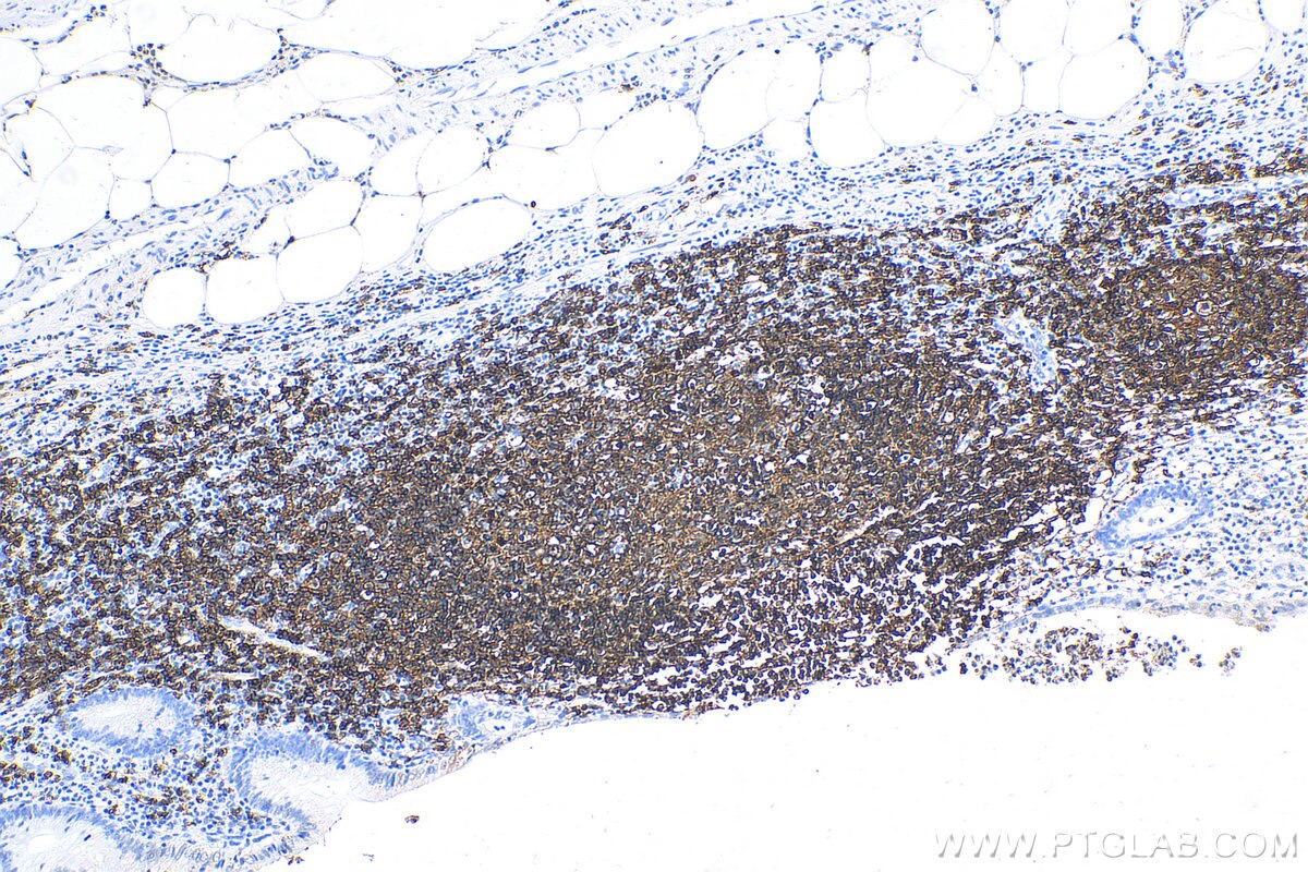 Immunohistochemistry (IHC) staining of human appendicitis tissue using CD20 Polyclonal antibody (24828-1-AP)