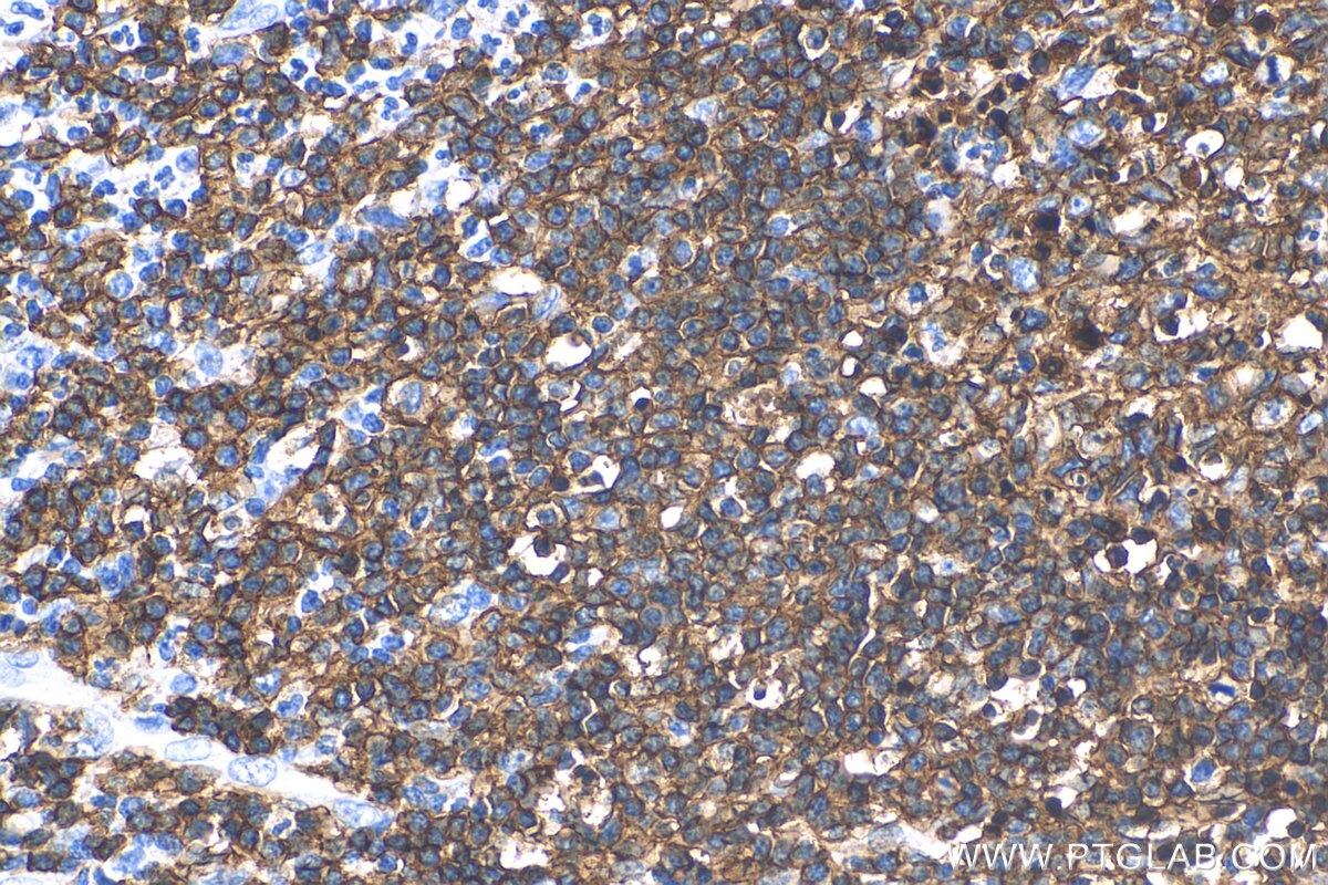 Immunohistochemistry (IHC) staining of human appendicitis tissue using CD20 Polyclonal antibody (24828-1-AP)