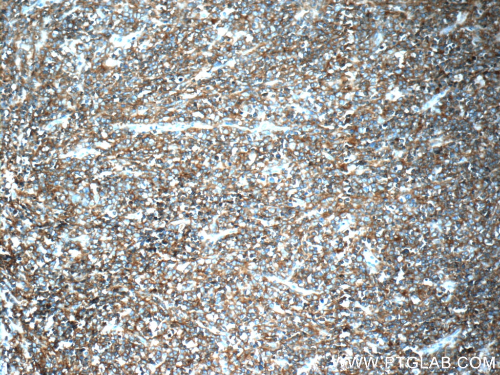 Immunohistochemistry (IHC) staining of human lymphoma tissue using CD20 Polyclonal antibody (24828-1-AP)