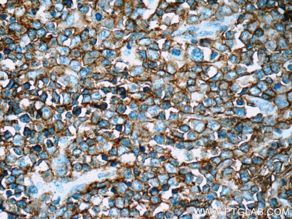 Immunohistochemistry (IHC) staining of human lymphoma tissue using CD20 Polyclonal antibody (24828-1-AP)