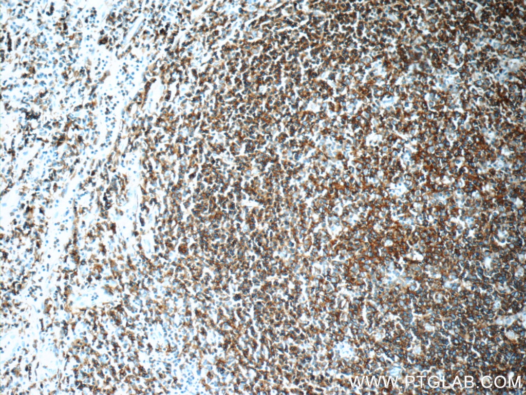 Immunohistochemistry (IHC) staining of human tonsillitis tissue using CD20 Polyclonal antibody (24828-1-AP)