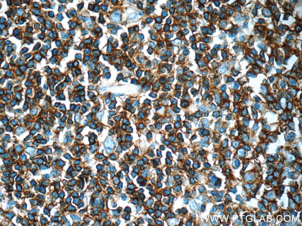 Immunohistochemistry (IHC) staining of human tonsillitis tissue using CD20 Polyclonal antibody (24828-1-AP)