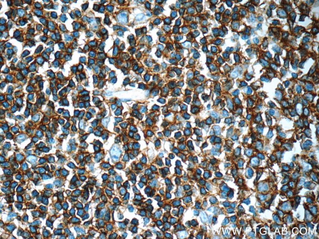 IHC staining of human tonsillitis using 24828-1-AP