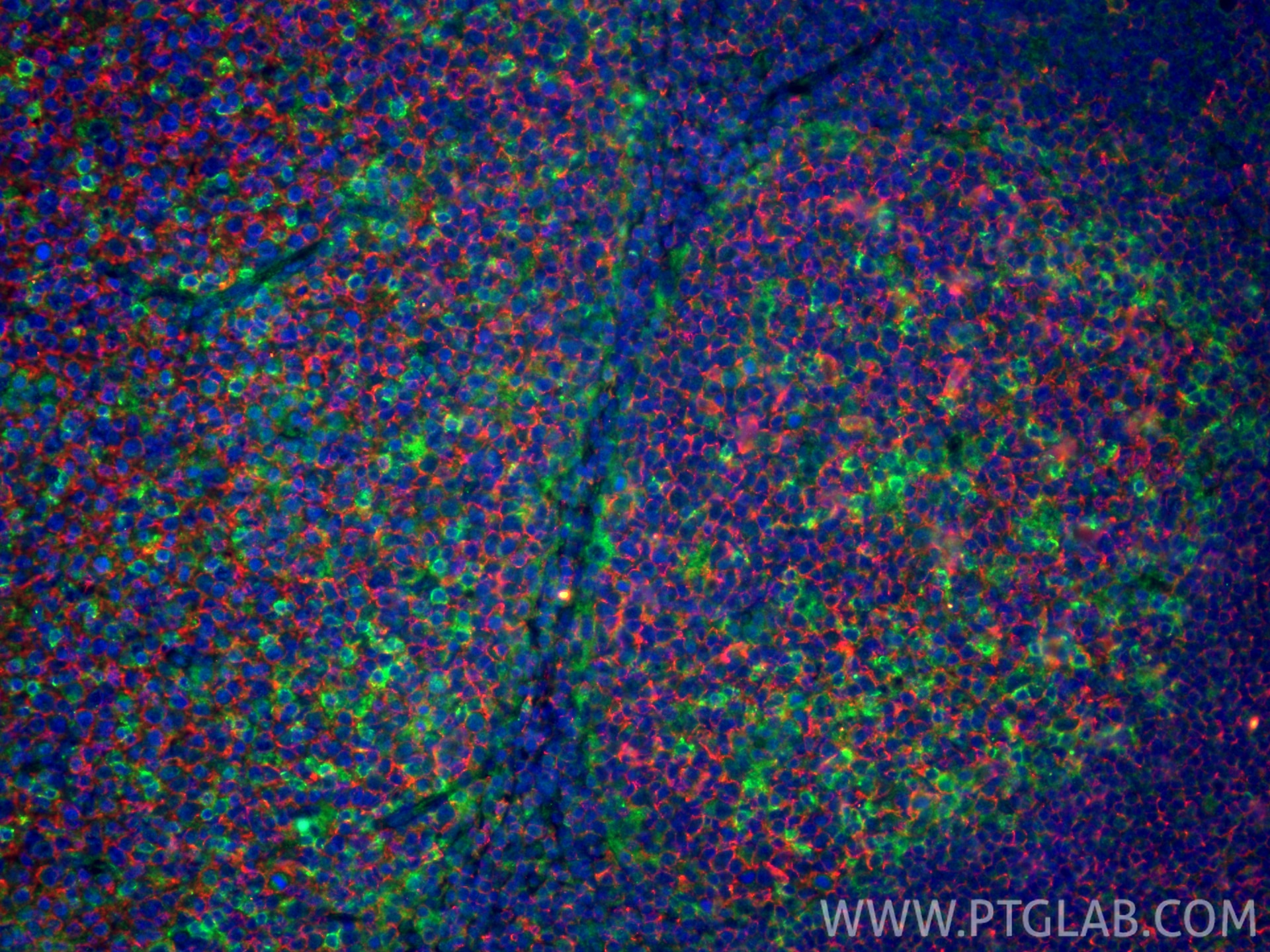 IF Staining of human tonsillitis using 60271-1-Ig Immunofluorescence (IF) / fluorescent staining of human tonsillitis tissue using CD20 Monoclonal antibody (60271-1-Ig)