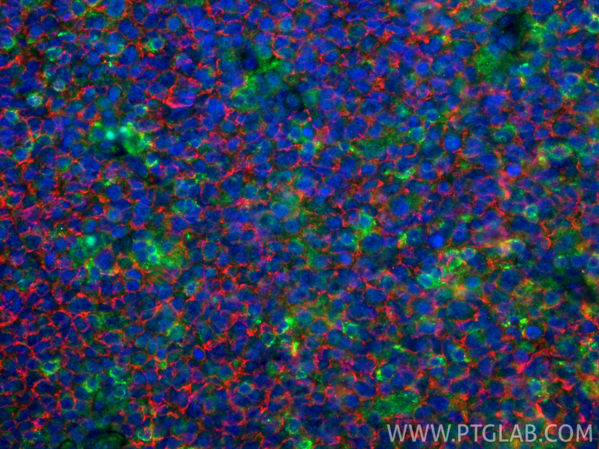 IF Staining of human tonsillitis using 60271-1-Ig Immunofluorescence (IF) / fluorescent staining of human tonsillitis tissue using CD20 Monoclonal antibody (60271-1-Ig)