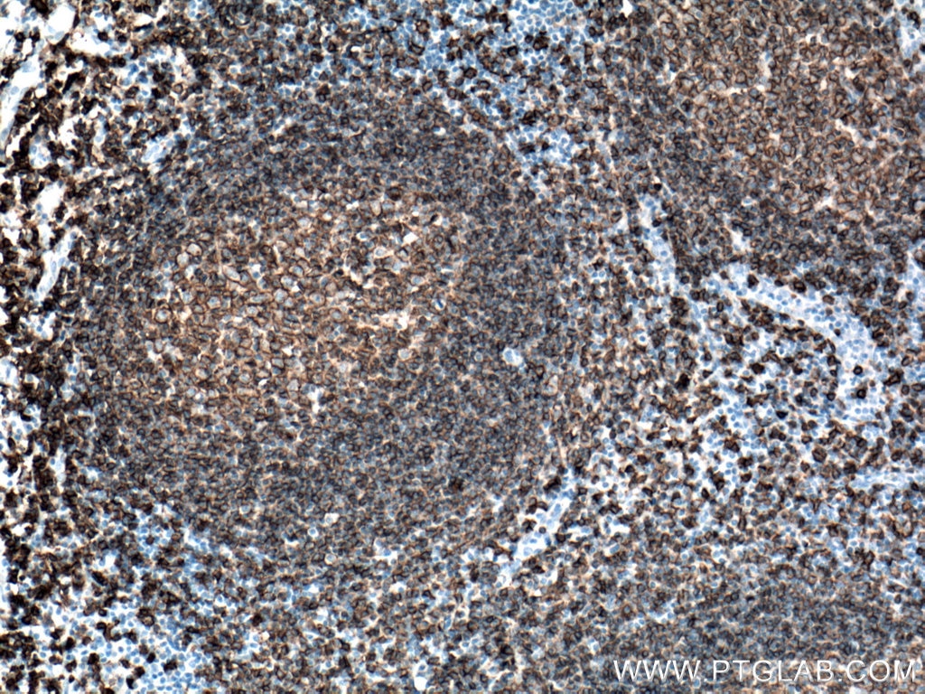 Immunohistochemistry (IHC) staining of human tonsillitis tissue using CD20 Monoclonal antibody (60271-1-Ig)