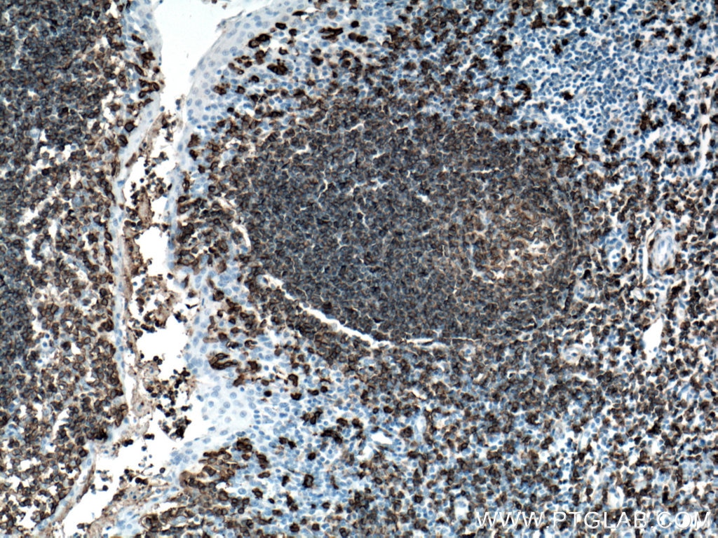 Immunohistochemistry (IHC) staining of human tonsillitis tissue using CD20 Monoclonal antibody (60271-1-Ig)