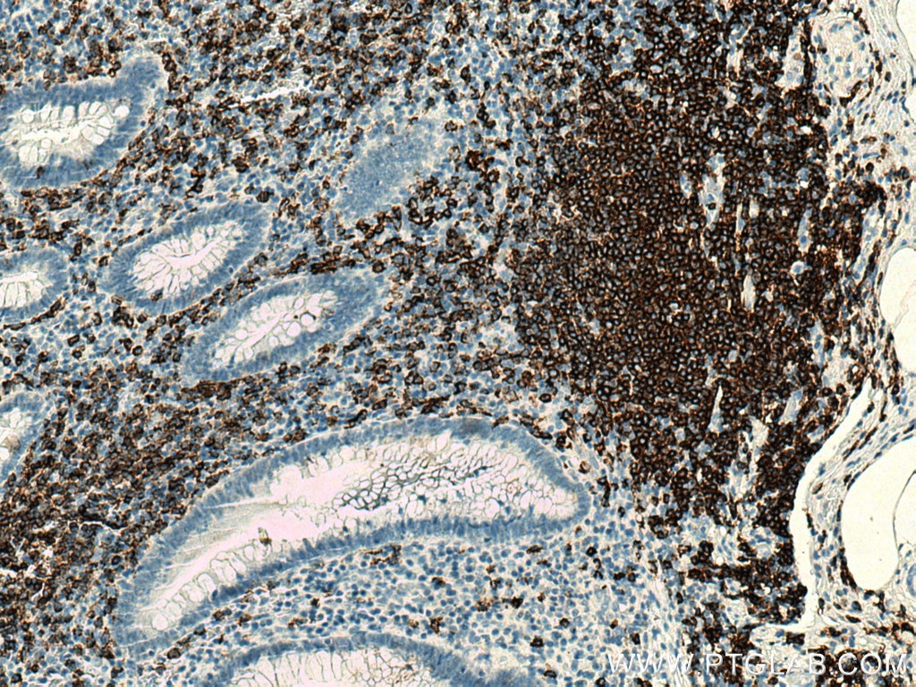 Immunohistochemistry (IHC) staining of human appendicitis tissue using CD20 Monoclonal antibody (60271-1-Ig)