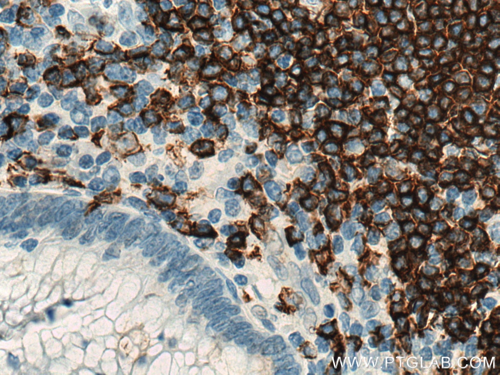 Immunohistochemistry (IHC) staining of human appendicitis tissue using CD20 Monoclonal antibody (60271-1-Ig)