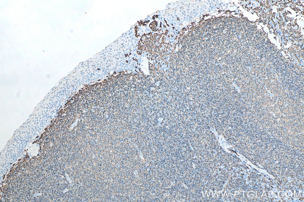 IHC staining of human tonsillitis using 60271-1-Ig Immunohistochemistry (IHC) staining of human tonsillitis tissue using CD20 Monoclonal antibody (60271-1-Ig)