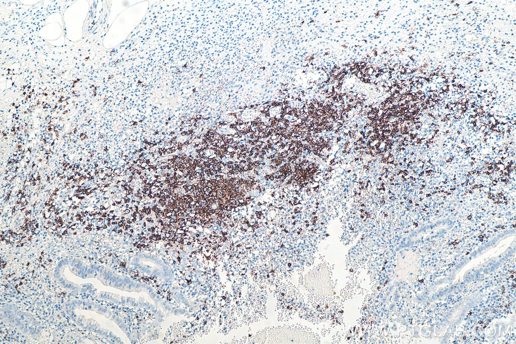 IHC staining of human appendicitis using 60271-1-Ig Immunohistochemistry (IHC) staining of human appendicitis tissue using CD20 Monoclonal antibody (60271-1-Ig)