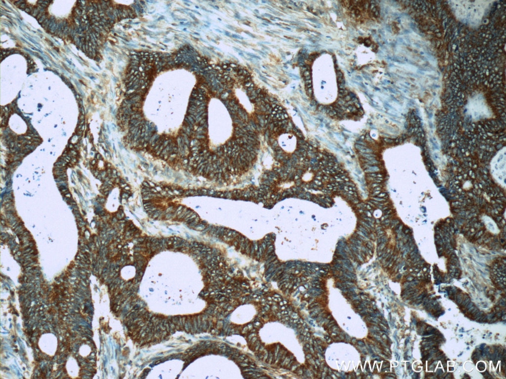 Immunohistochemistry (IHC) staining of human colon cancer tissue using MS4A12 Polyclonal antibody (13293-1-AP)