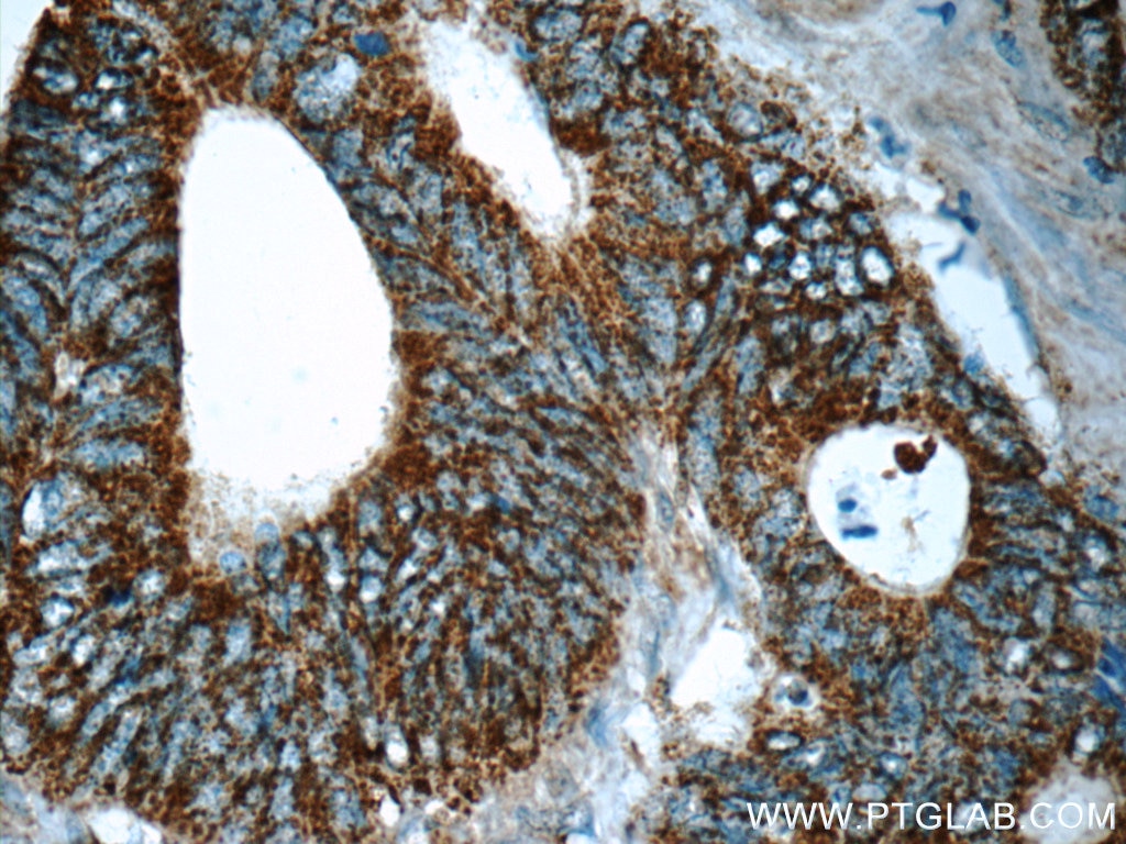 Immunohistochemistry (IHC) staining of human colon cancer tissue using MS4A12 Polyclonal antibody (13293-1-AP)