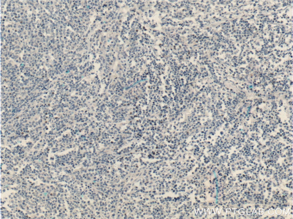 Immunohistochemistry (IHC) staining of human lymphoma tissue using MSC Polyclonal antibody (25028-1-AP)