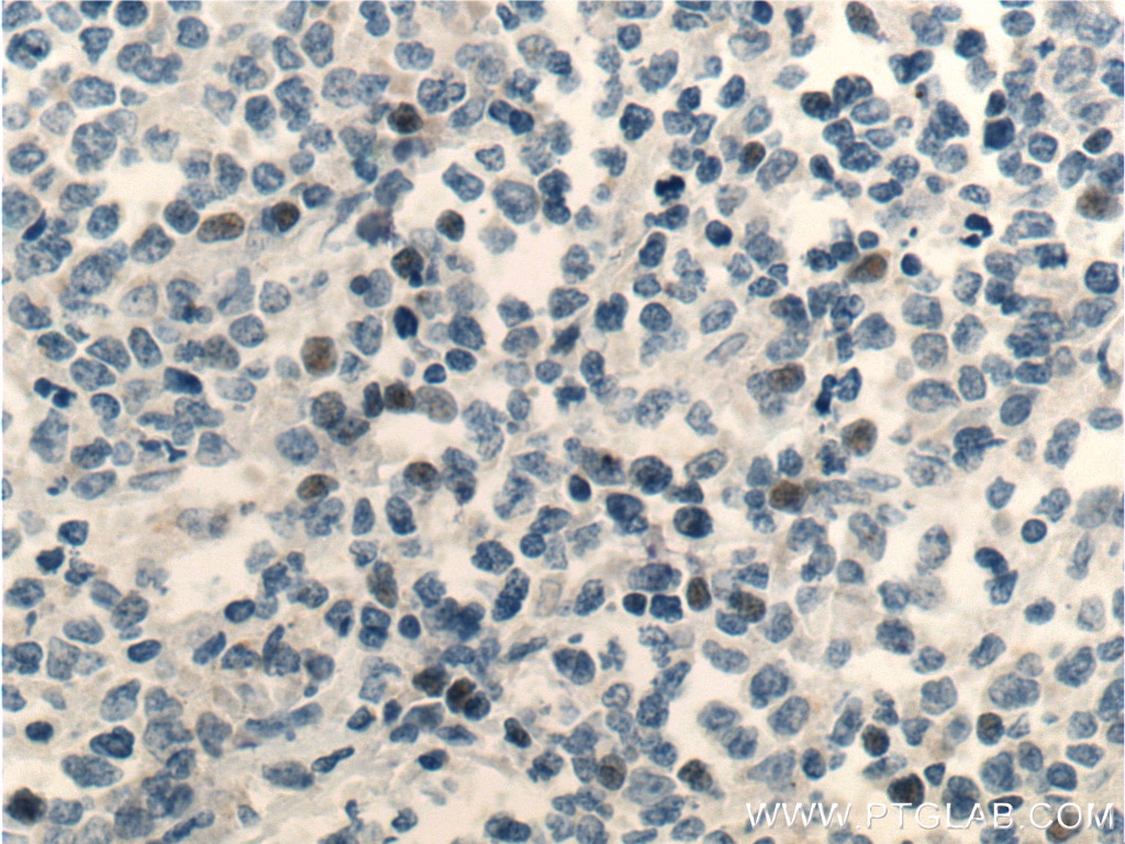 Immunohistochemistry (IHC) staining of human lymphoma tissue using MSC Polyclonal antibody (25028-1-AP)